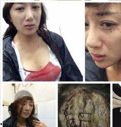 女明星受伤图片,女明星意外受伤，现场照片令人揪心