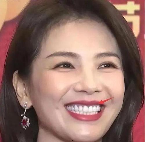 明星 牙龈萎缩,揭秘口腔健康危机与预防之道